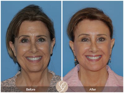 Deep Plane Facelift Before & After Gallery - Patient 450440 - Image 1