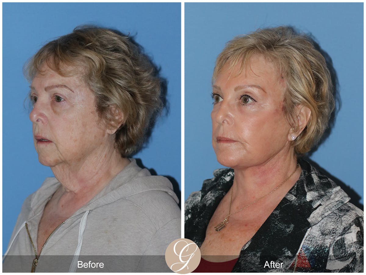 Neck Lift Before & After Gallery - Patient 191617 - Image 3