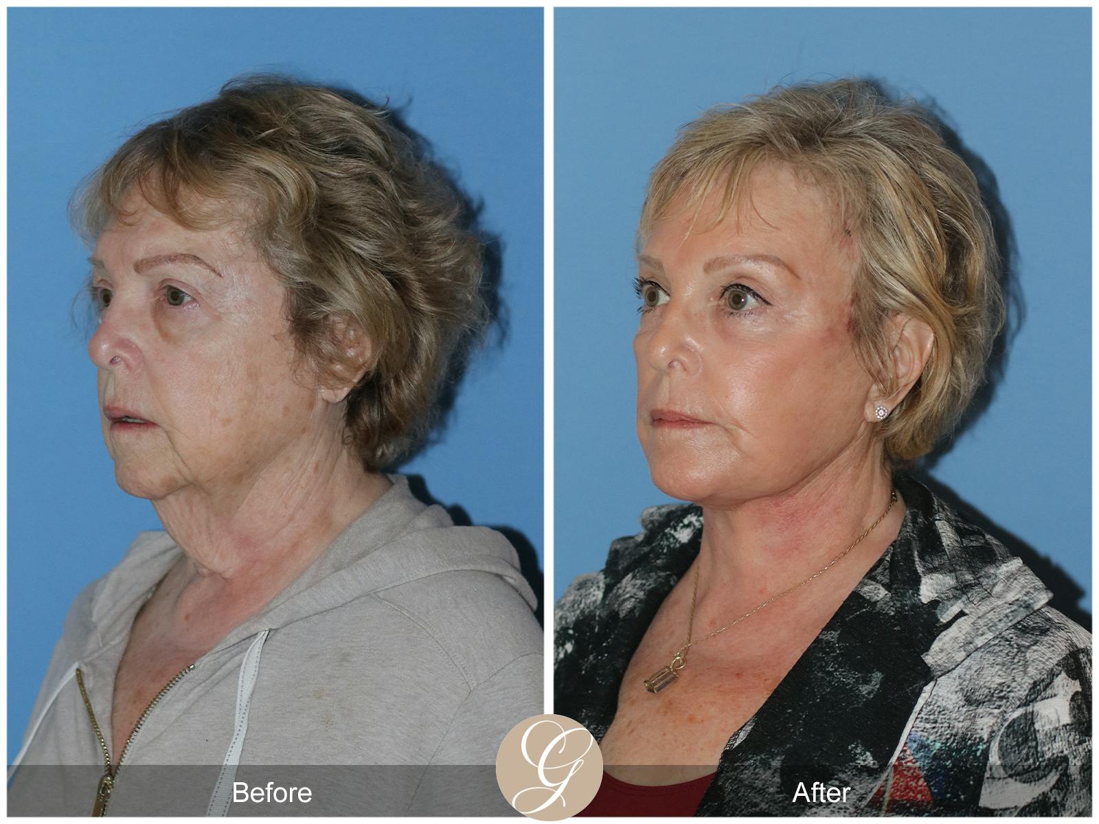 Neck Lift Before & After Gallery - Patient 191617 - Image 3