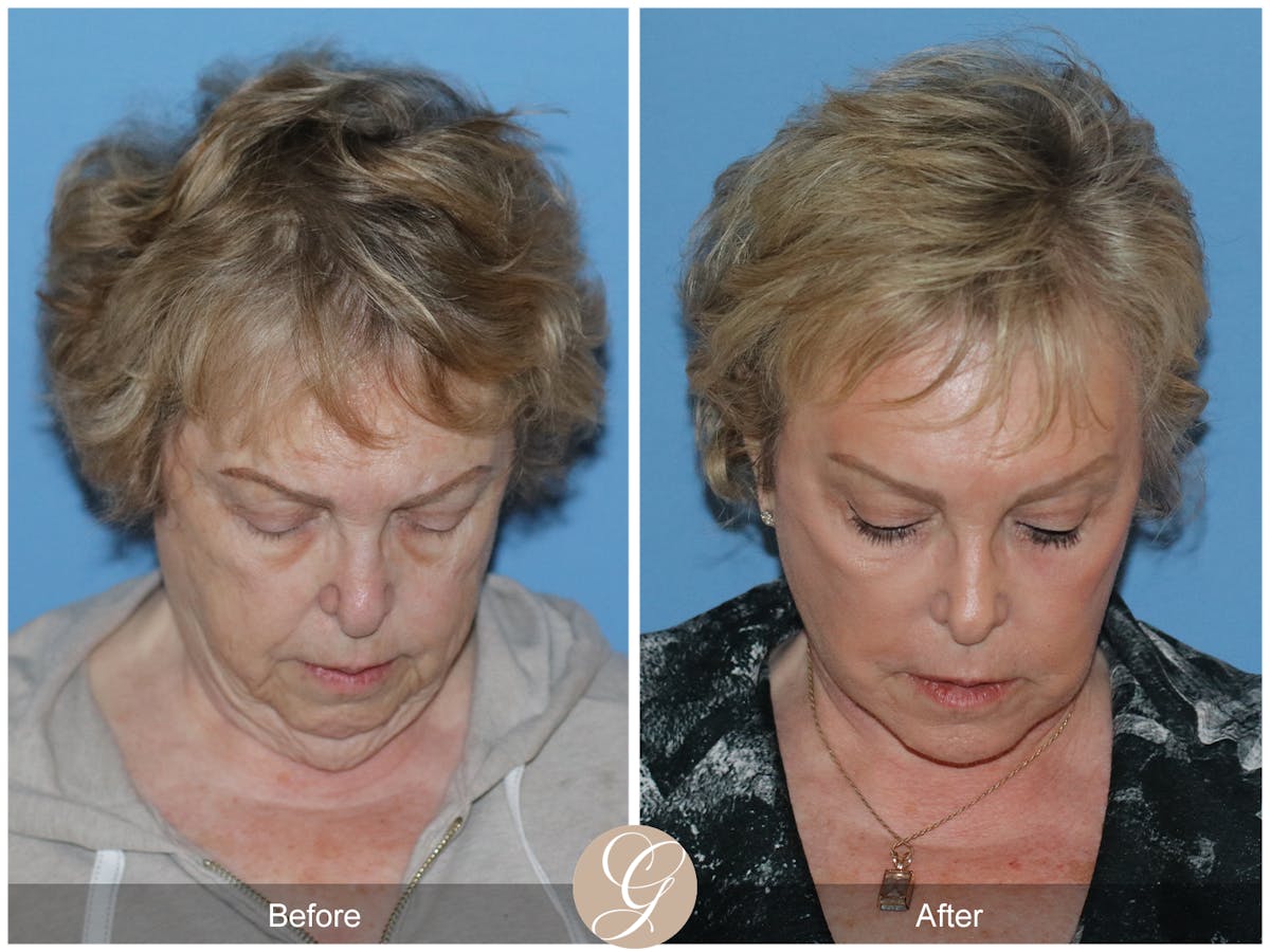 Neck Lift Before & After Gallery - Patient 191617 - Image 5