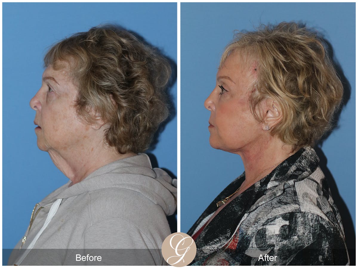 Neck Lift Before & After Gallery - Patient 191617 - Image 2