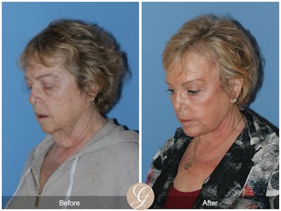 Neck Lift Before & After Gallery - Patient 191617 - Image 1