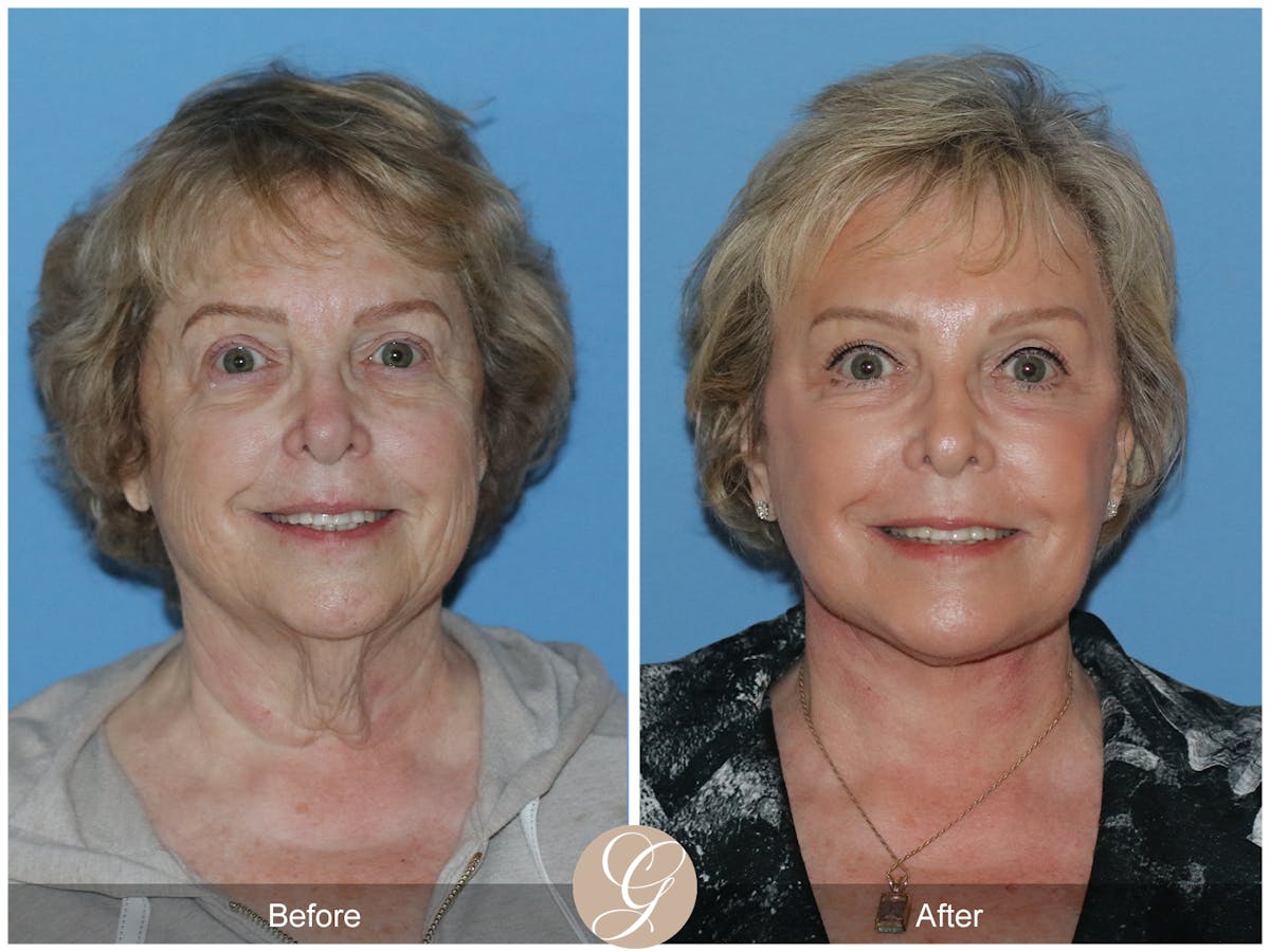 Neck Lift Before & After Gallery - Patient 191617 - Image 4