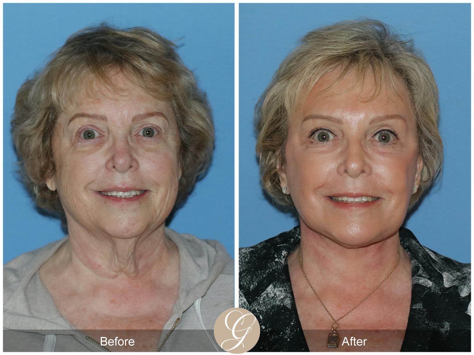 Neck Lift Before & After Gallery - Patient 191617 - Image 4