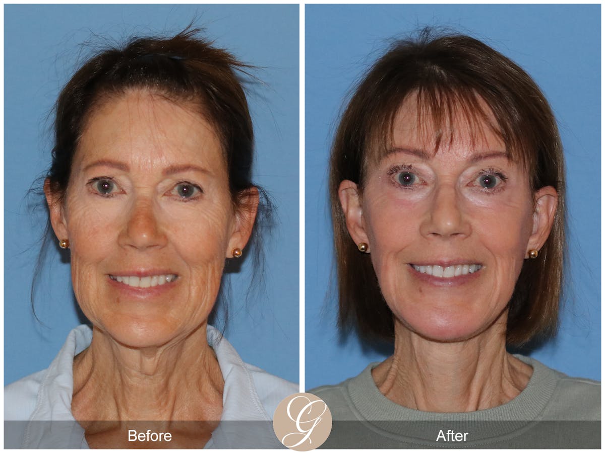 Neck Lift Before & After Gallery - Patient 138273 - Image 3