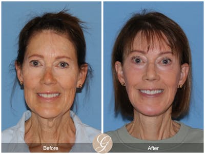 Deep Plane Facelift Before & After Gallery - Patient 217044 - Image 1