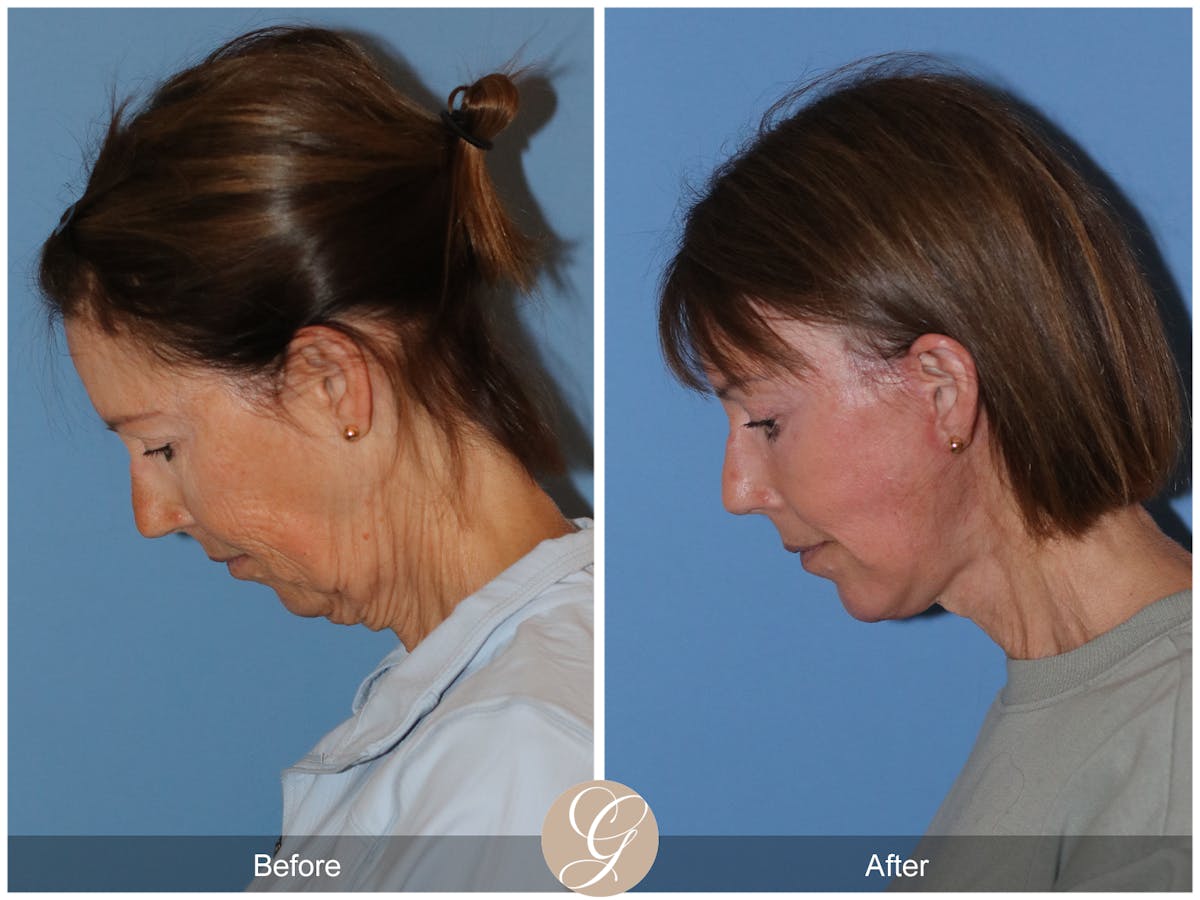 Neck Lift Before & After Gallery - Patient 138273 - Image 1