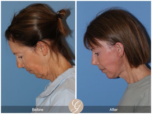 Neck Lift Newport Beach | Platysmaplasty | Dr. Kevin Sadati