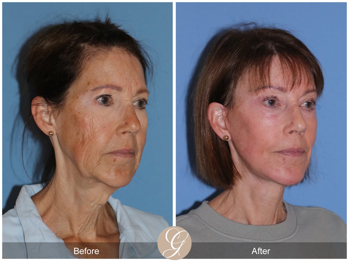 Neck Lift Before & After Gallery - Patient 138273 - Image 5
