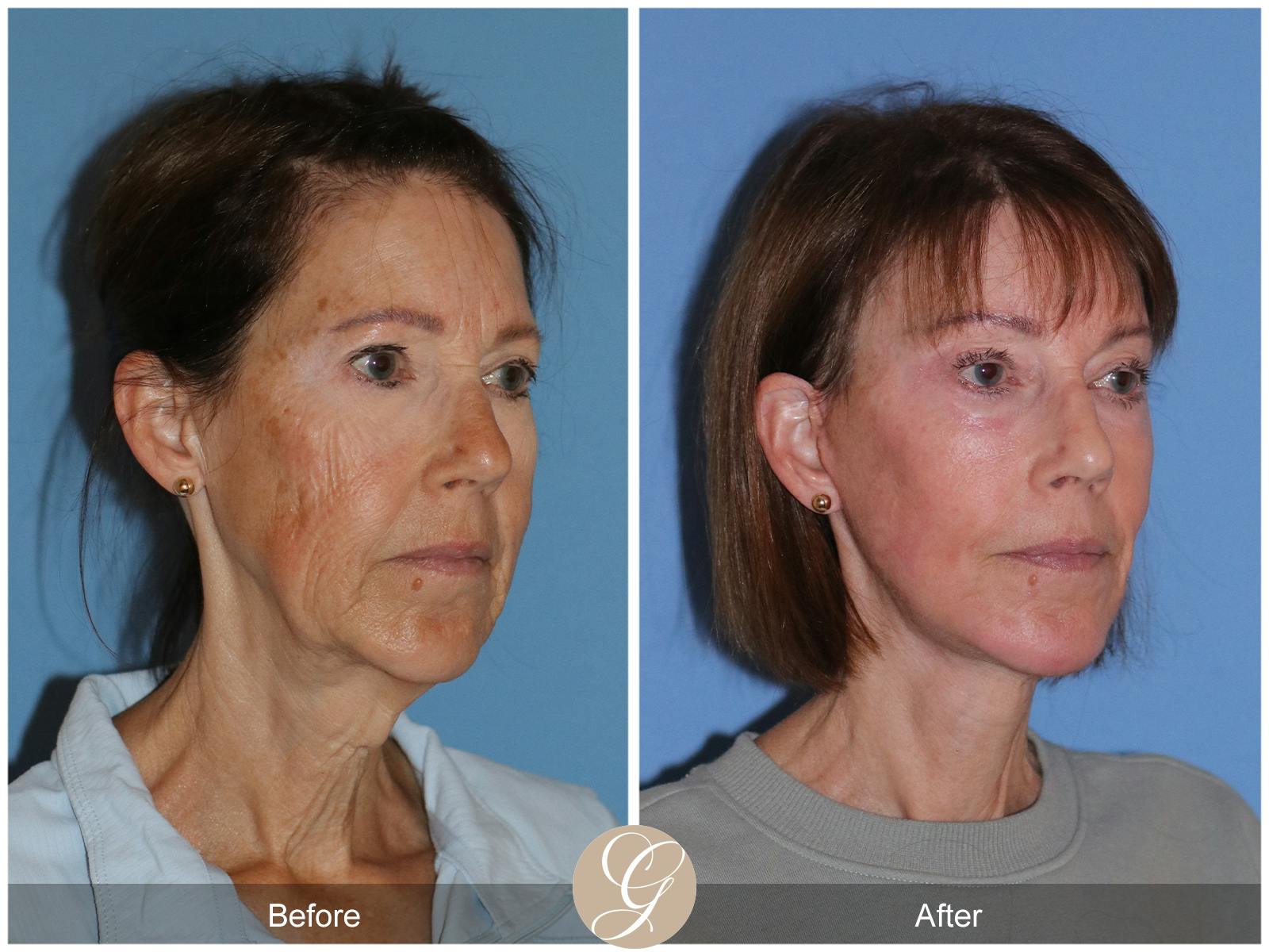 Neck Lift Before & After Gallery - Patient 138273 - Image 5