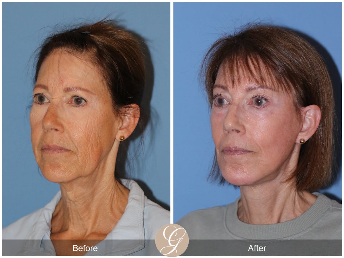 Neck Lift Before & After Gallery - Patient 138273 - Image 2
