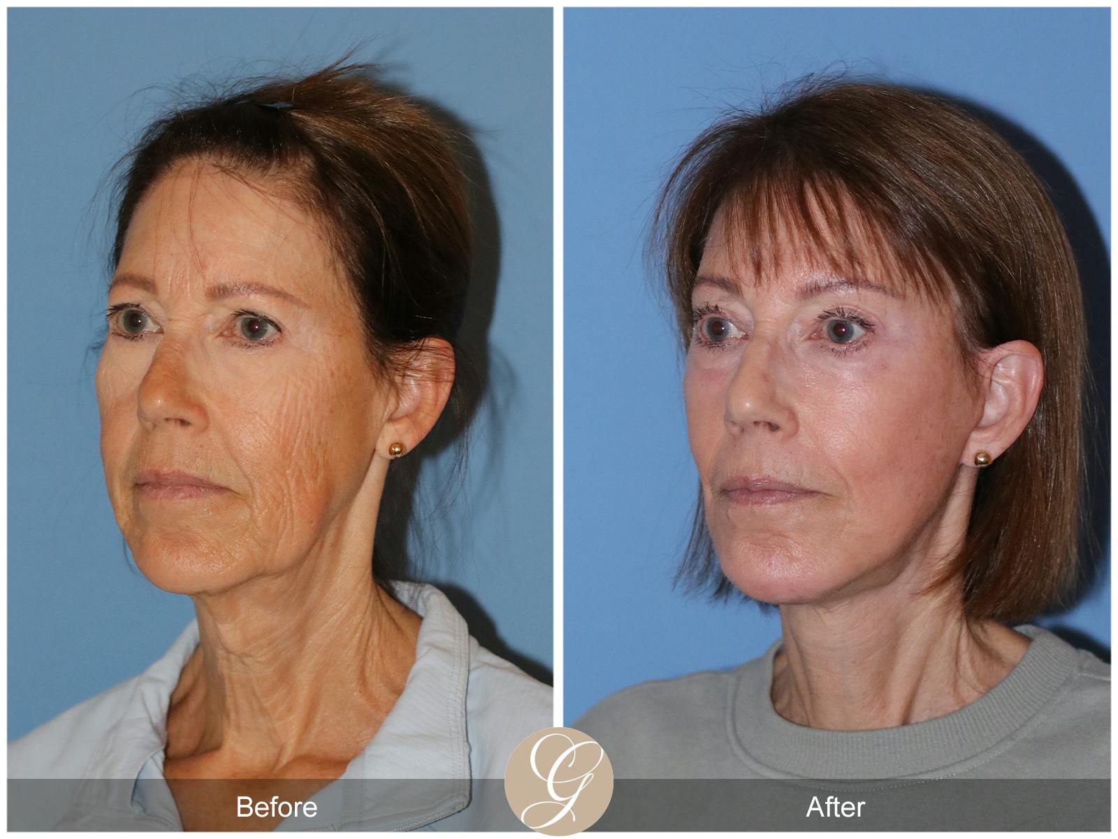Neck Lift Before & After Gallery - Patient 138273 - Image 2