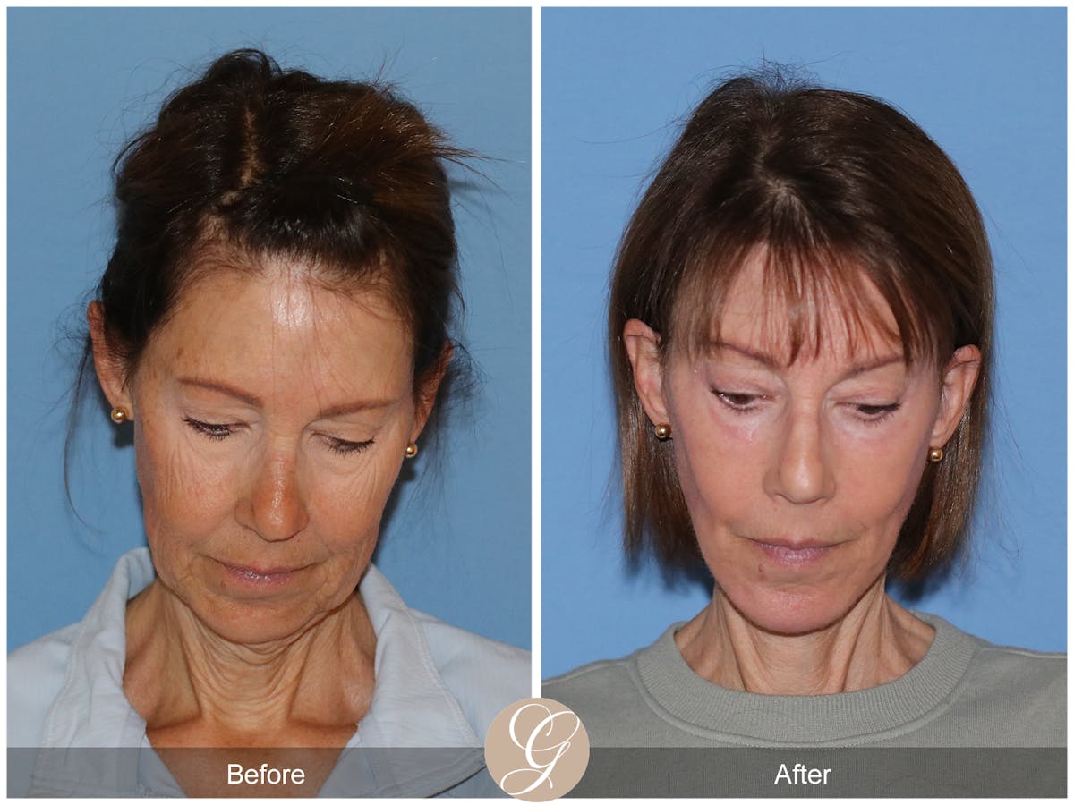 Neck Lift Before & After Gallery - Patient 138273 - Image 4