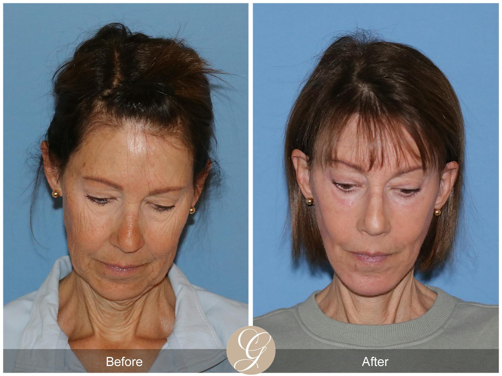 Neck Lift Before & After Gallery - Patient 138273 - Image 4