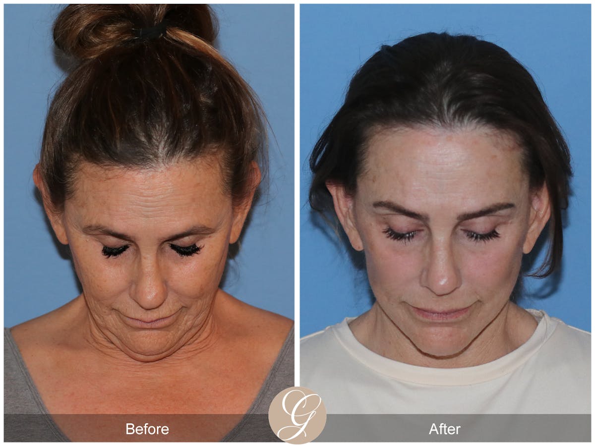 Neck Lift Before & After Gallery - Patient 343874 - Image 5