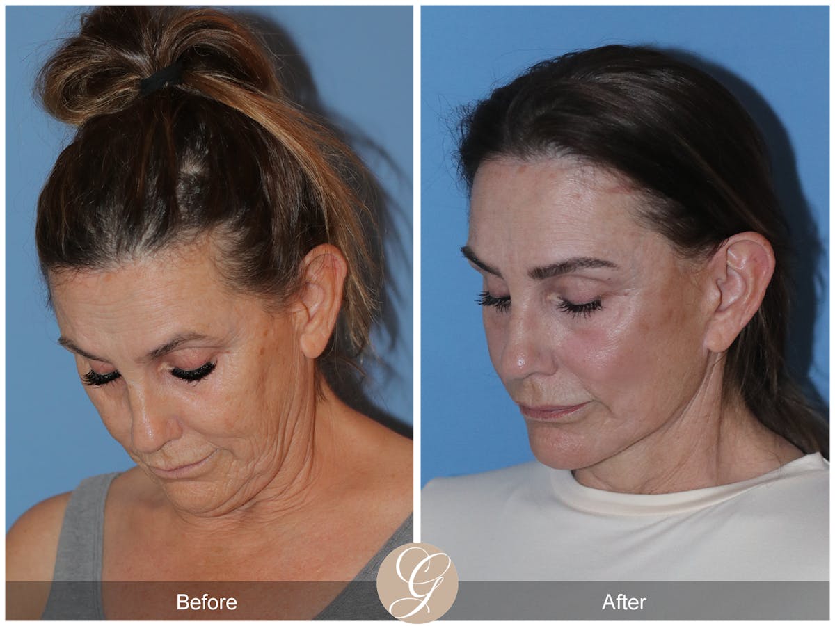 Neck Lift Before & After Gallery - Patient 343874 - Image 3