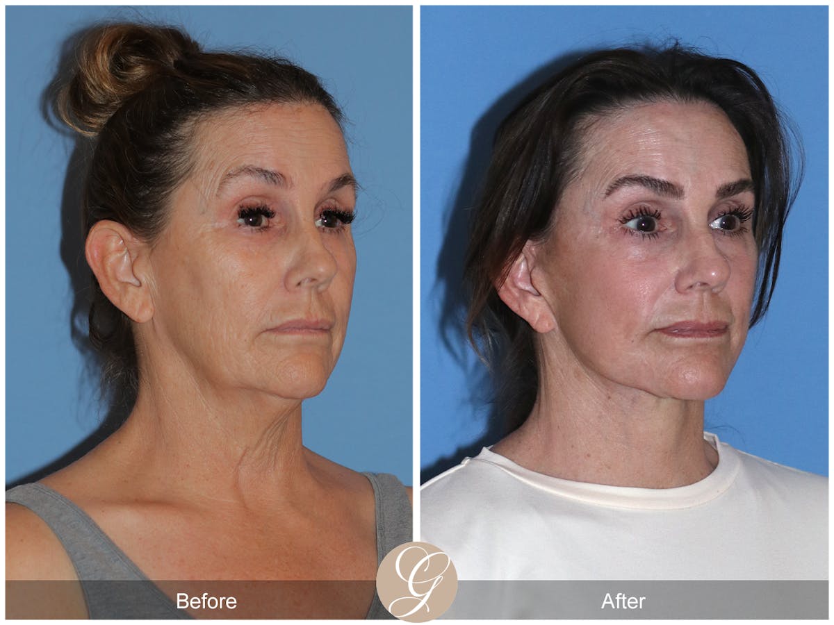 Neck Lift Before & After Gallery - Patient 343874 - Image 6