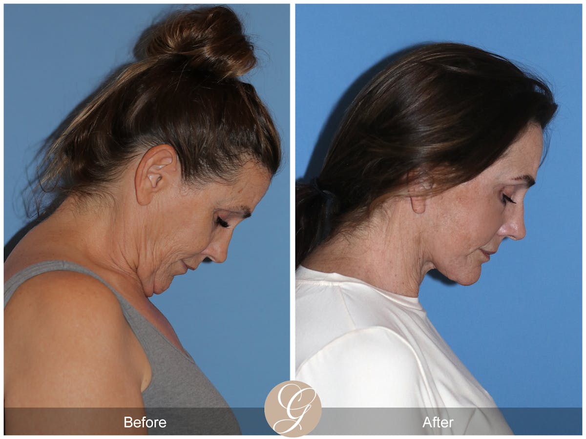 Neck Lift Before & After Gallery - Patient 343874 - Image 9
