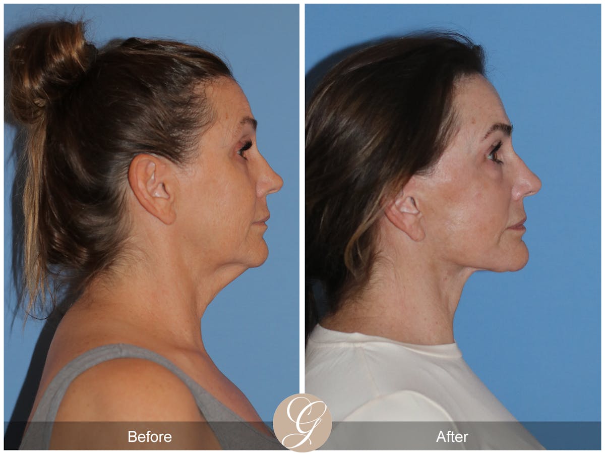 Neck Lift Before & After Gallery - Patient 343874 - Image 8