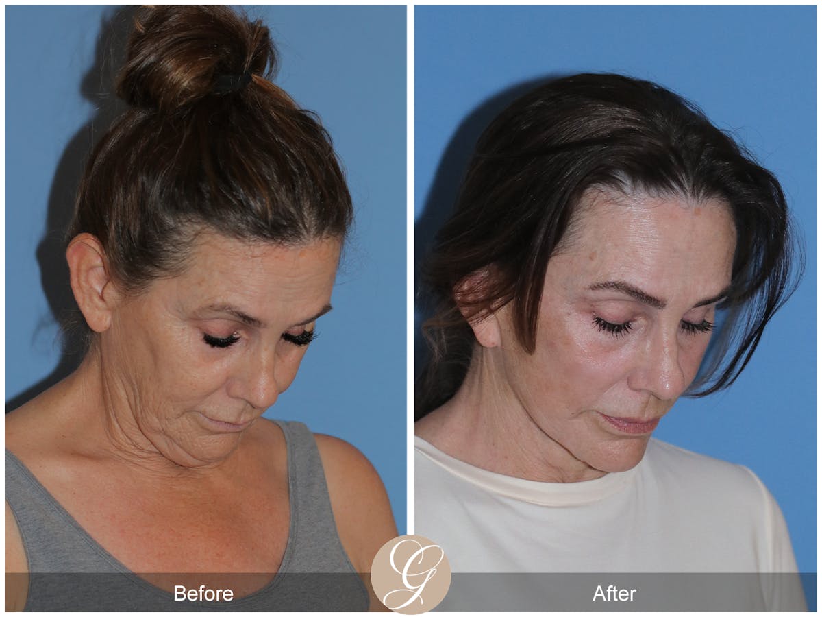 Neck Lift Before & After Gallery - Patient 343874 - Image 7