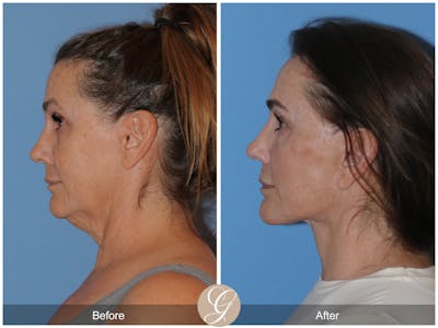 Neck Lift Before & After Gallery - Patient 343874 - Image 1