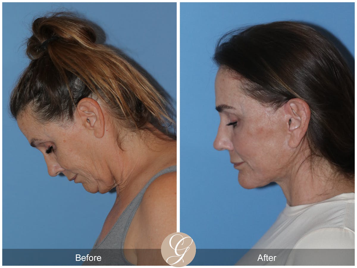 Neck Lift Before & After Gallery - Patient 343874 - Image 2