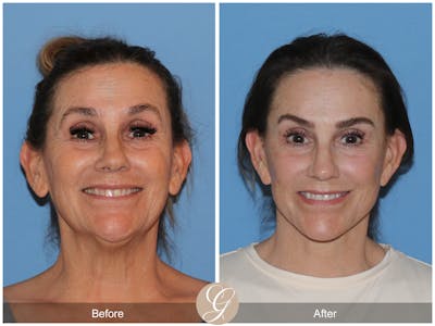 Preservation Facelift Before & After Gallery - Patient 232049 - Image 1