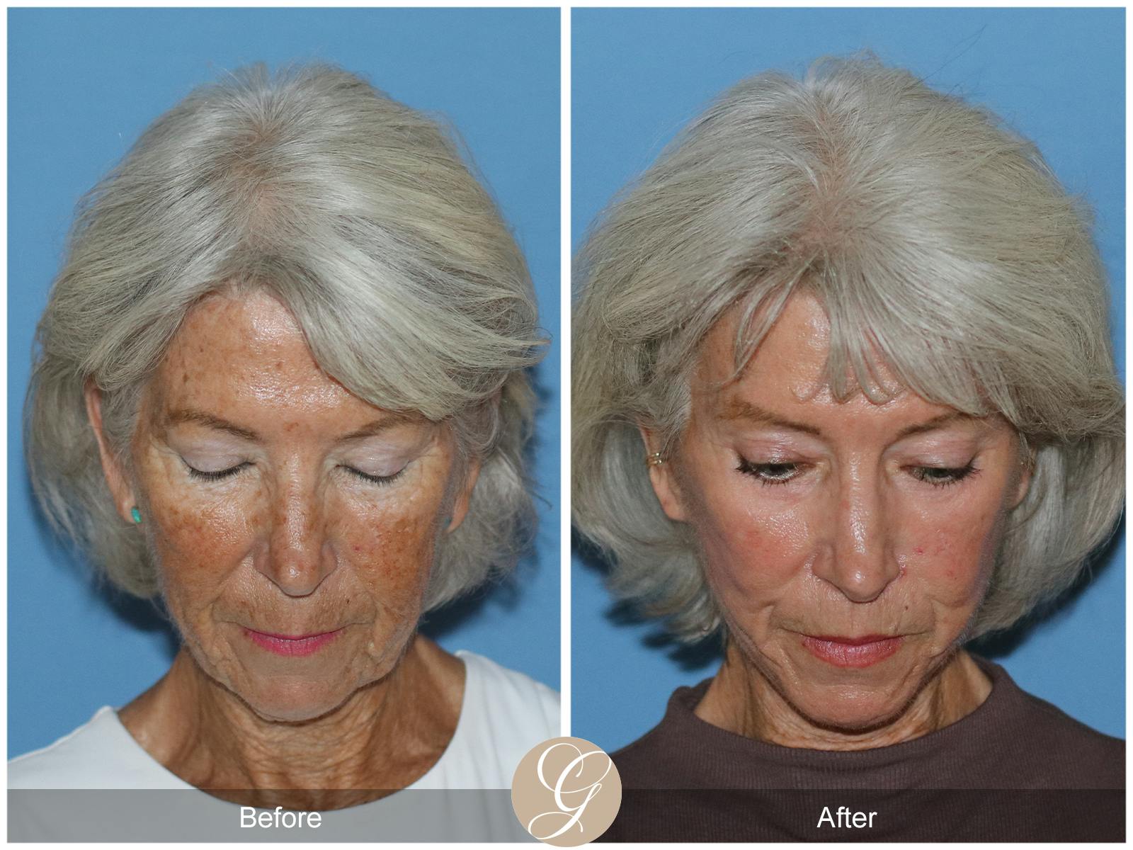 Neck Lift Before & After Gallery - Patient 370564 - Image 5