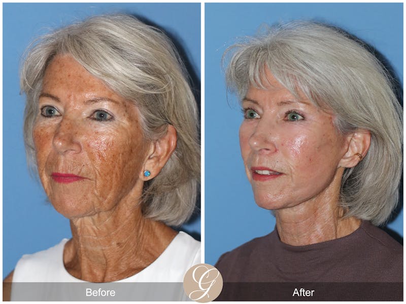 facelift patient before and after