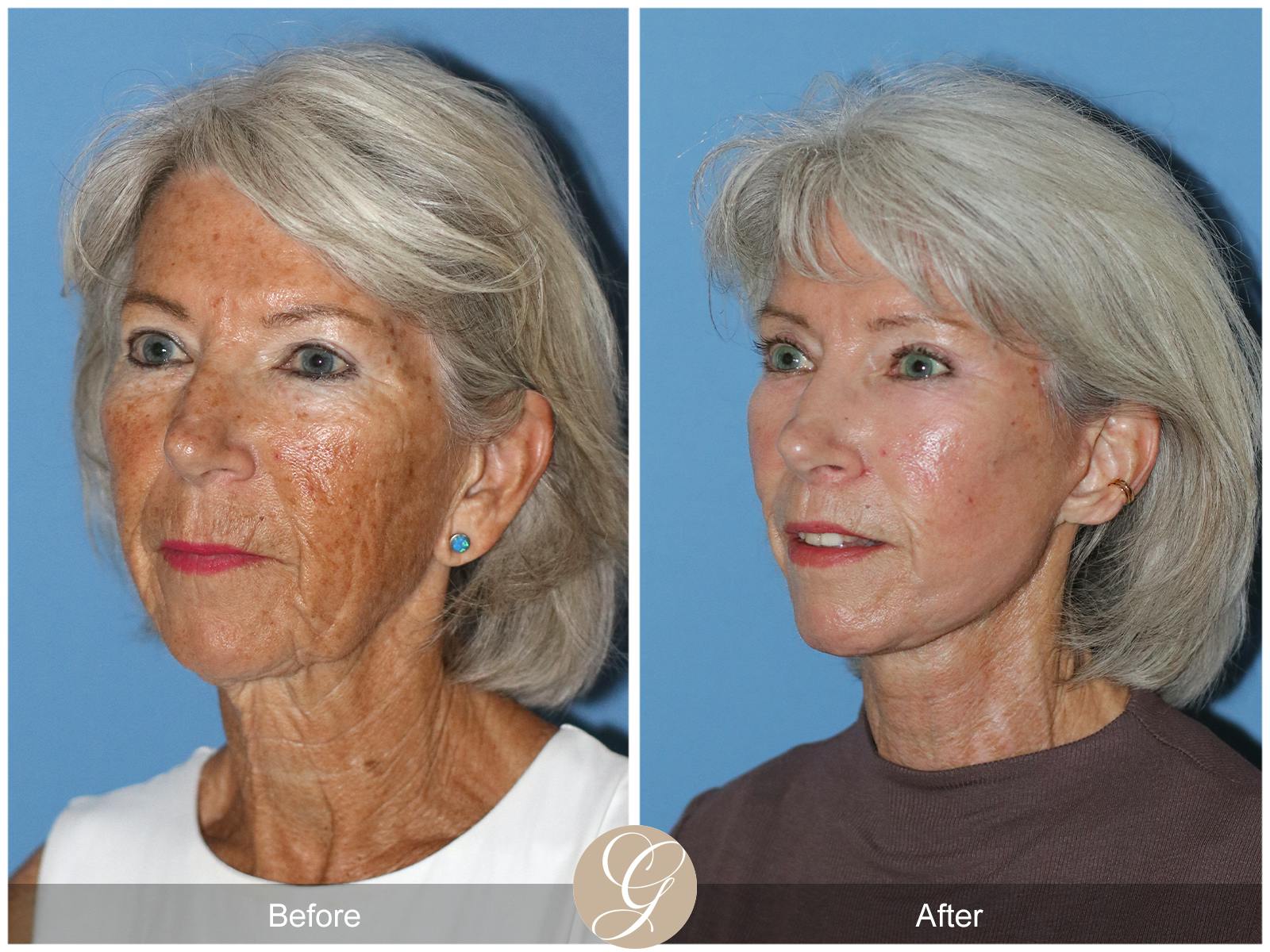 facelift patient before and after