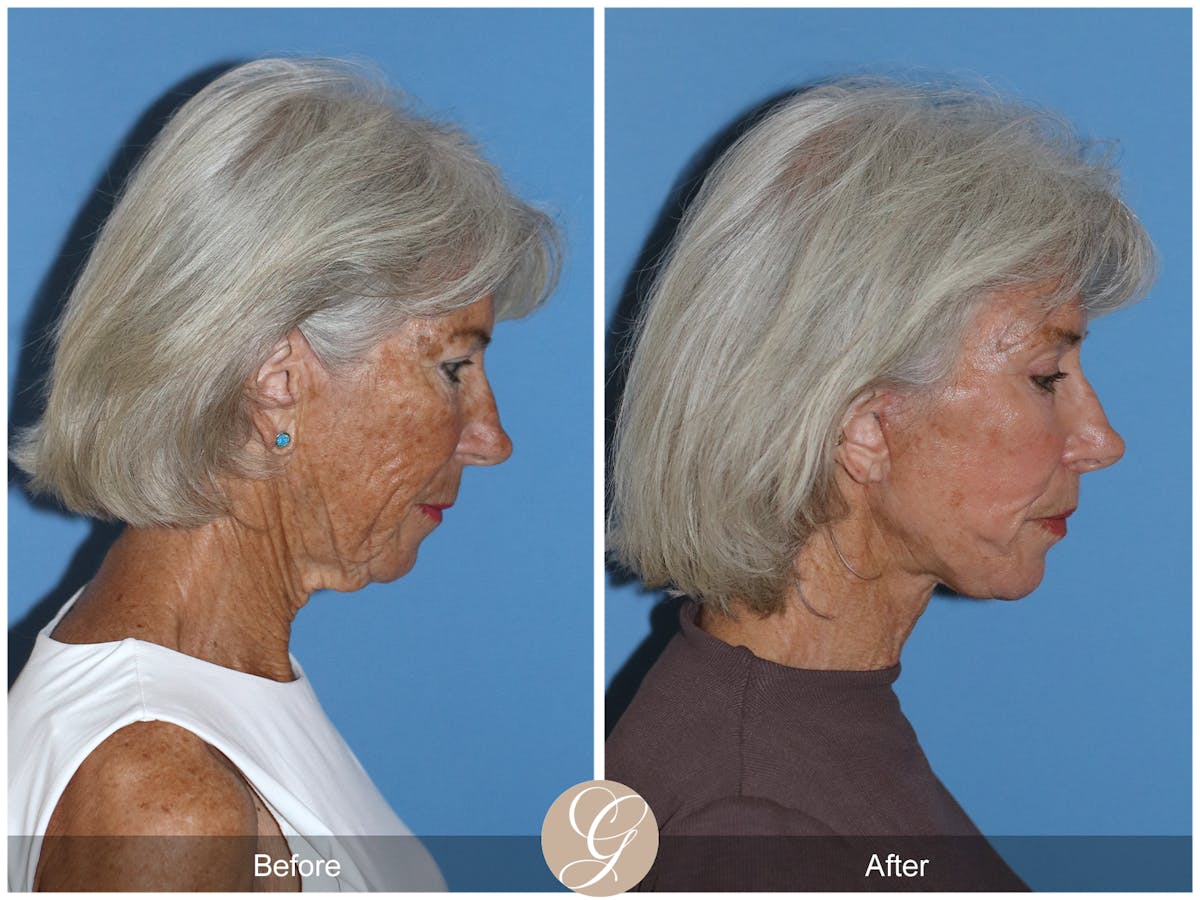 Neck Lift Before & After Gallery - Patient 370564 - Image 7