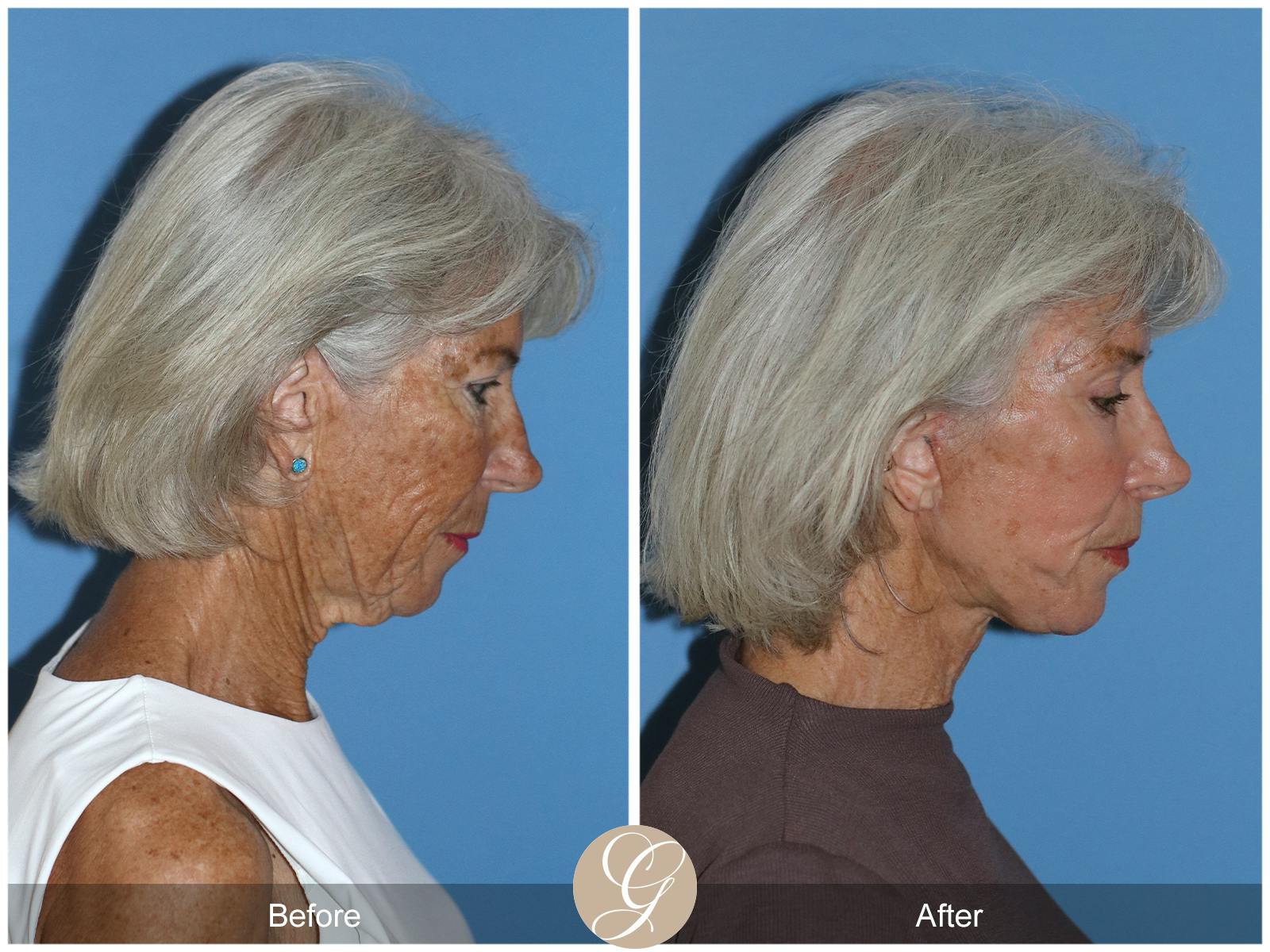 Neck Lift Before & After Gallery - Patient 370564 - Image 7