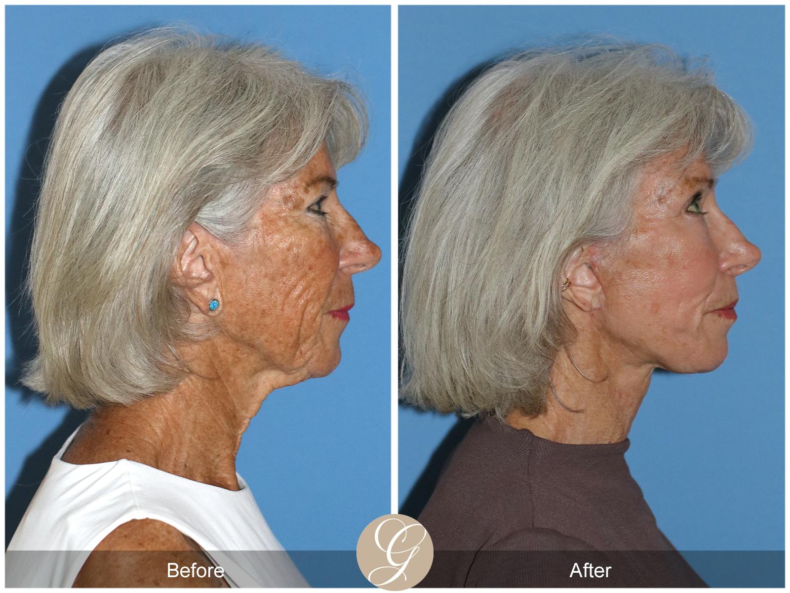 Neck Lift Before & After Gallery - Patient 370564 - Image 6
