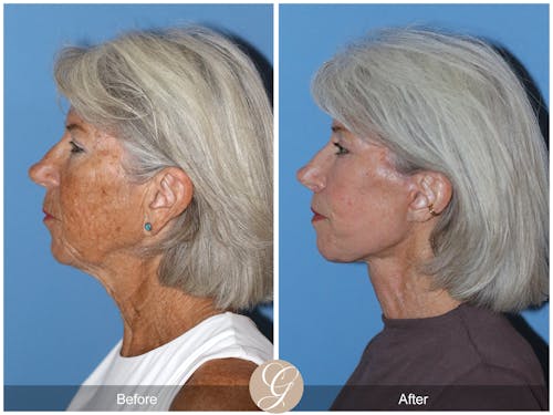 Neck Lift Newport Beach | Platysmaplasty | Dr. Kevin Sadati