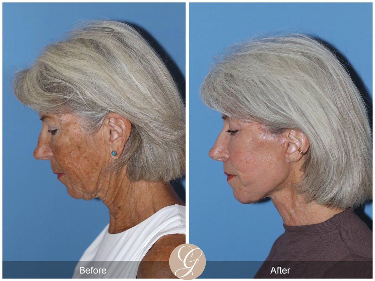 Neck Lift Before & After Gallery - Patient 370564 - Image 2