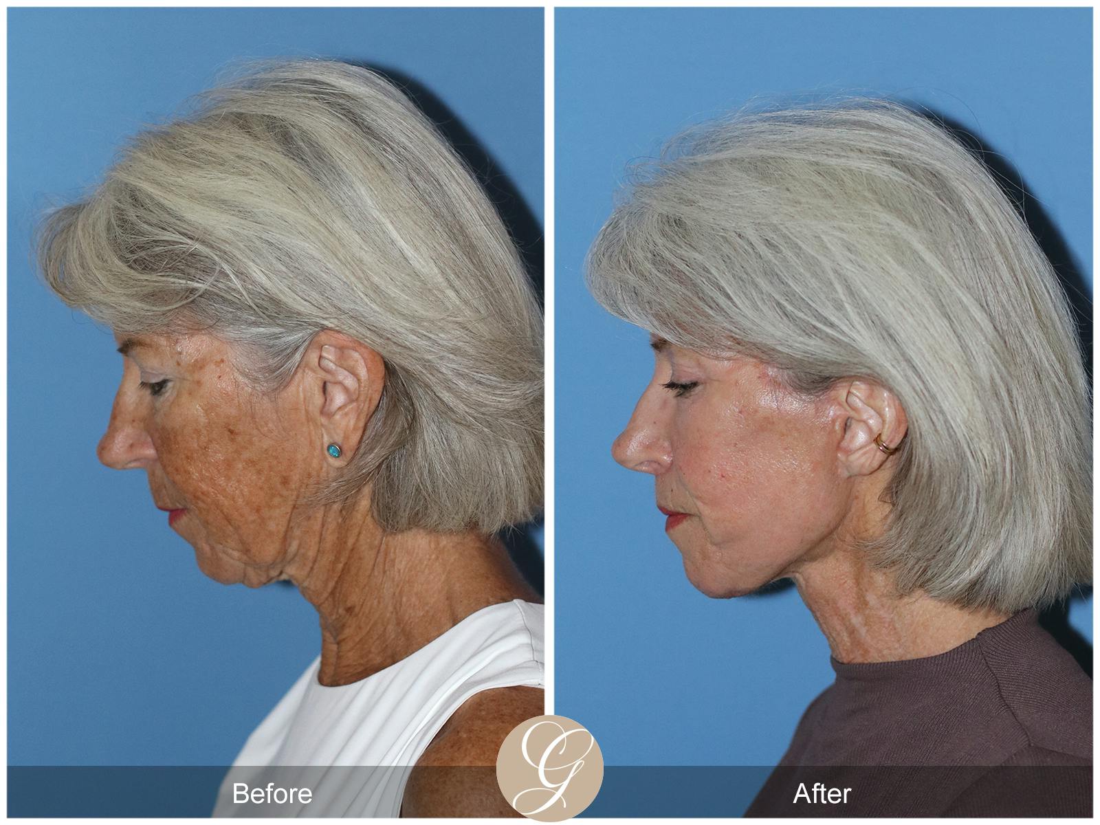 Neck Lift Before & After Gallery - Patient 370564 - Image 2