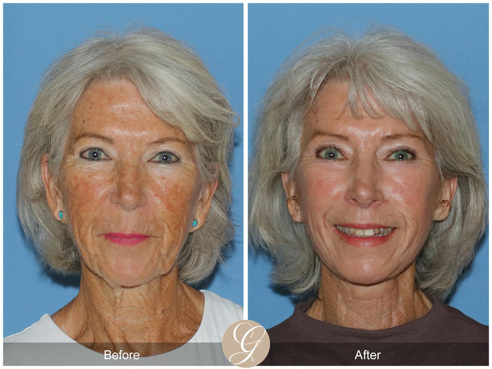 Neck Lift Before & After Gallery - Patient 370564 - Image 4