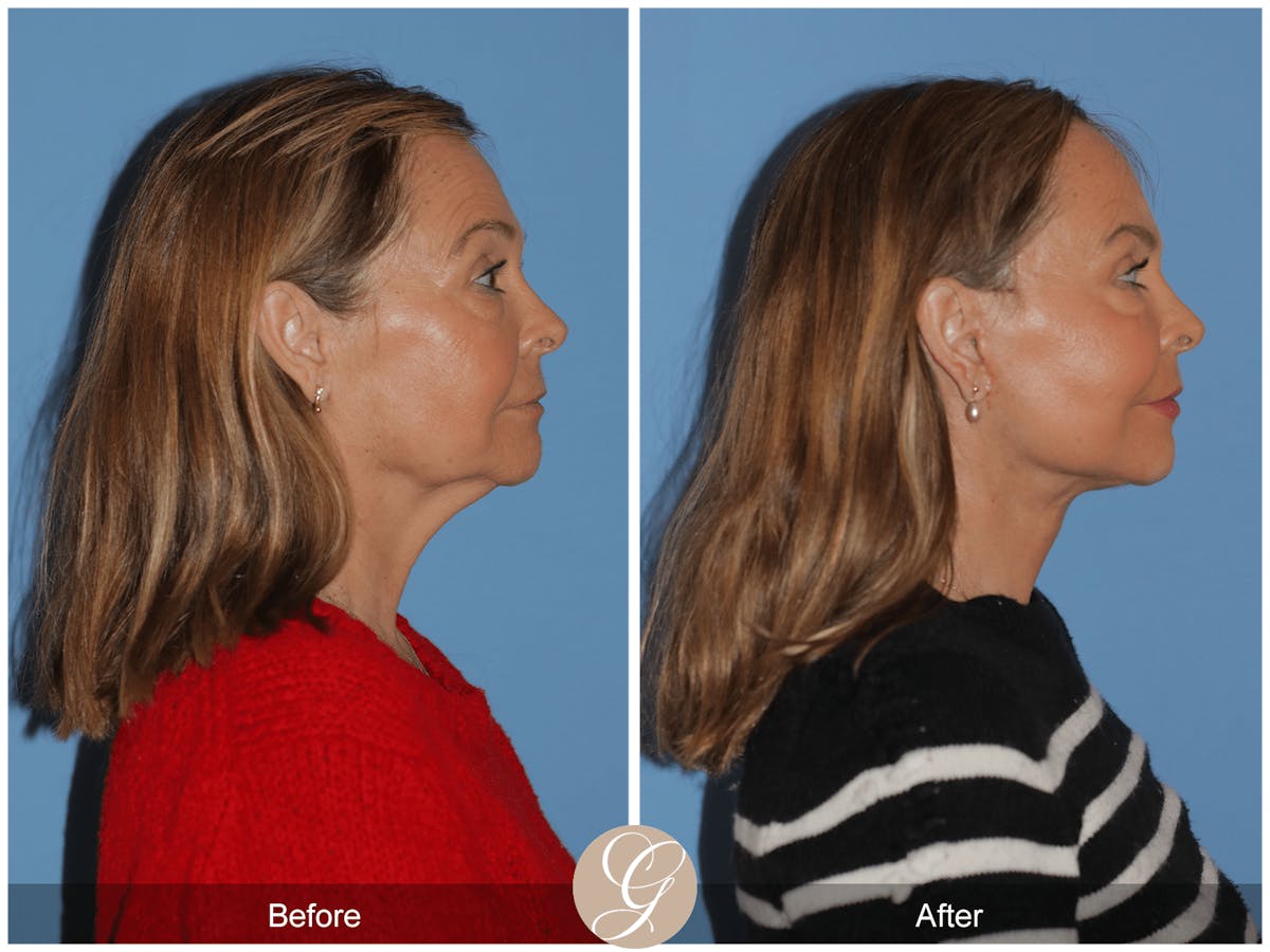 Preservation Facelift Before & After Gallery - Patient 296304 - Image 5