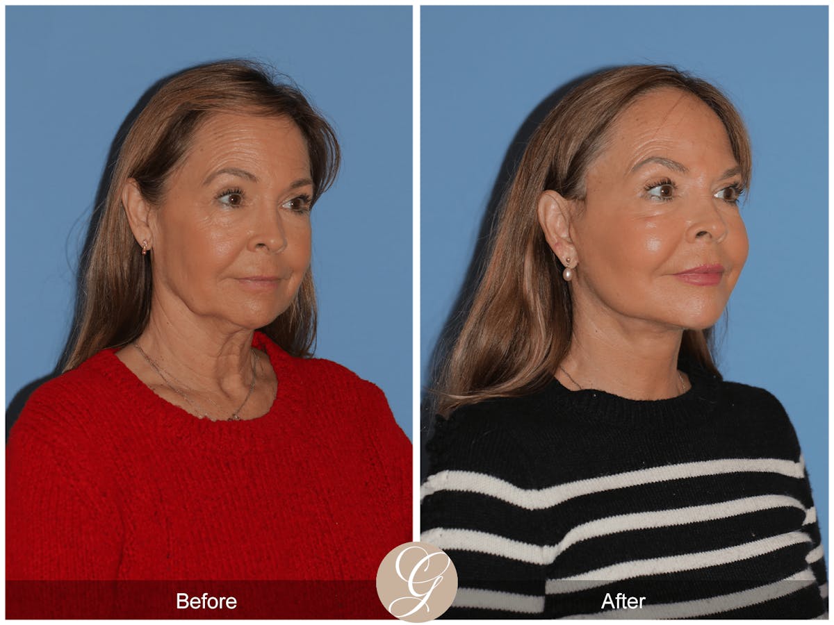 Preservation Facelift Before & After Gallery - Patient 296304 - Image 4