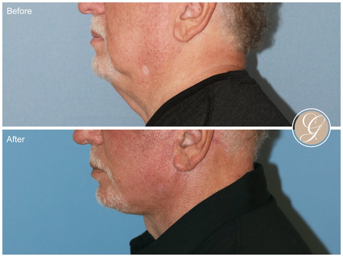 Facelift Male Before & After Gallery - Patient 123779 - Image 5