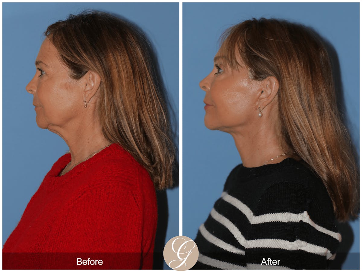Preservation Facelift Before & After Gallery - Patient 296304 - Image 7