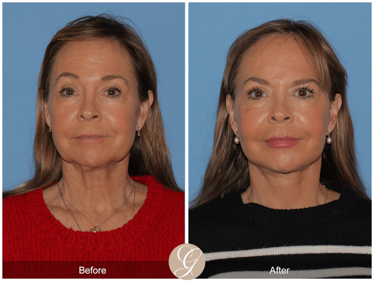 Preservation Facelift Before & After Gallery - Patient 296304 - Image 6