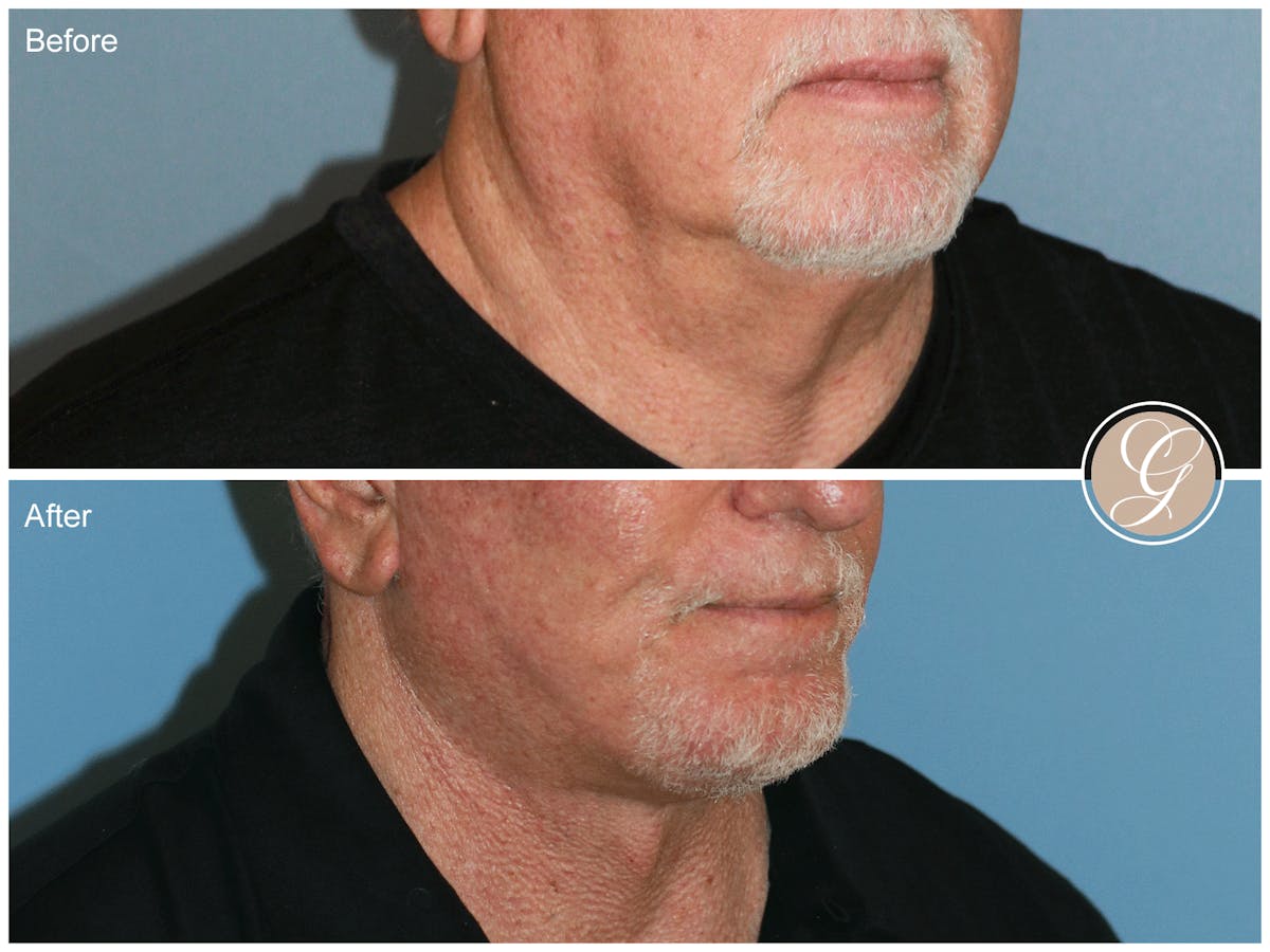 Facelift Male Before & After Gallery - Patient 123779 - Image 2