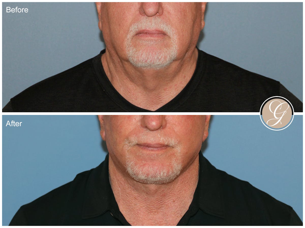 Facelift Male Before & After Gallery - Patient 123779 - Image 1