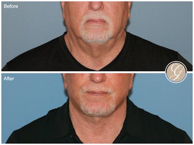Neck Lift Before & After Gallery - Patient 192403 - Image 1