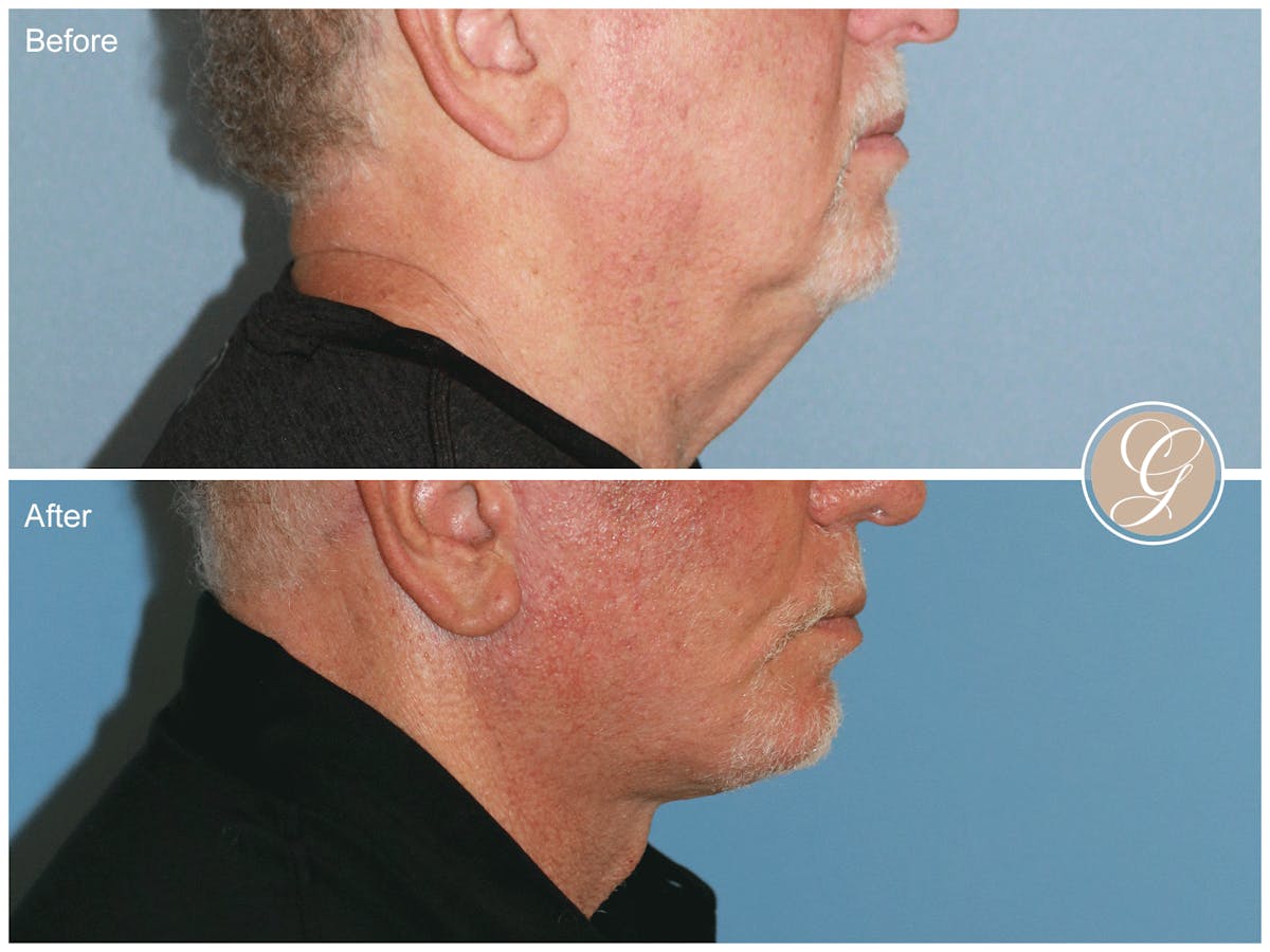Facelift Male Before & After Gallery - Patient 123779 - Image 3