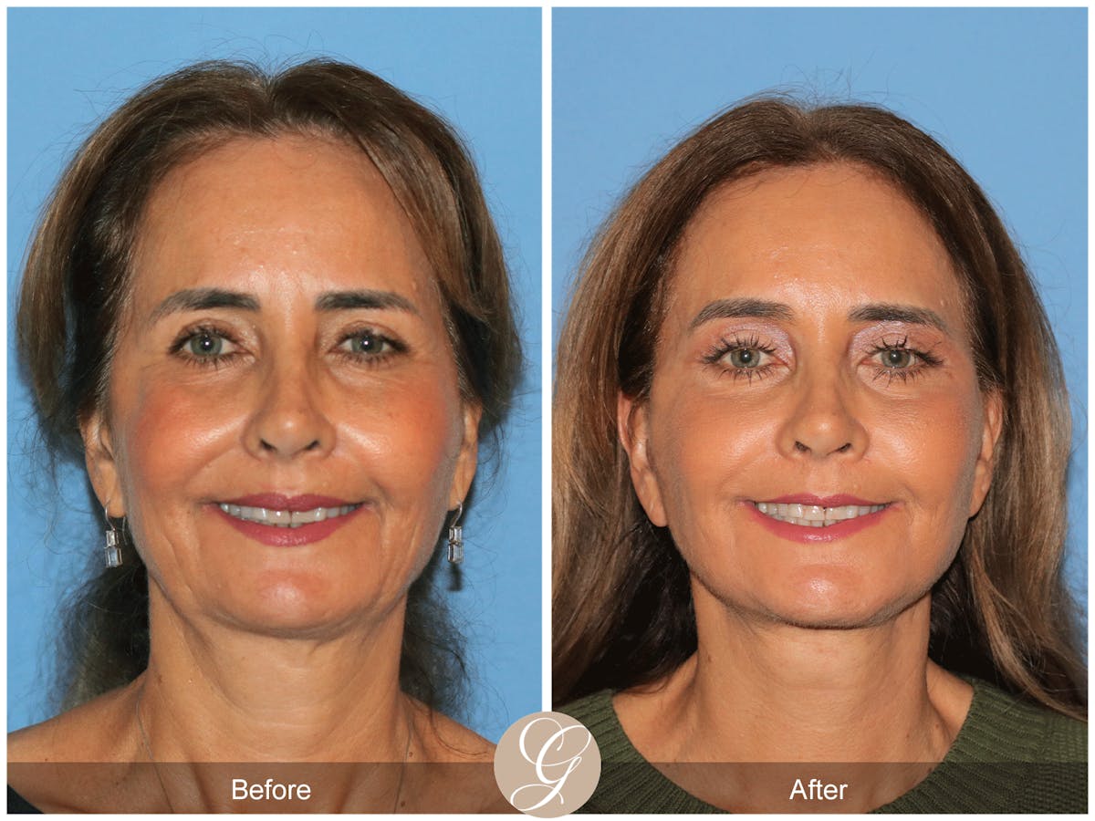Preservation Facelift Before & After Gallery - Patient 167839 - Image 1