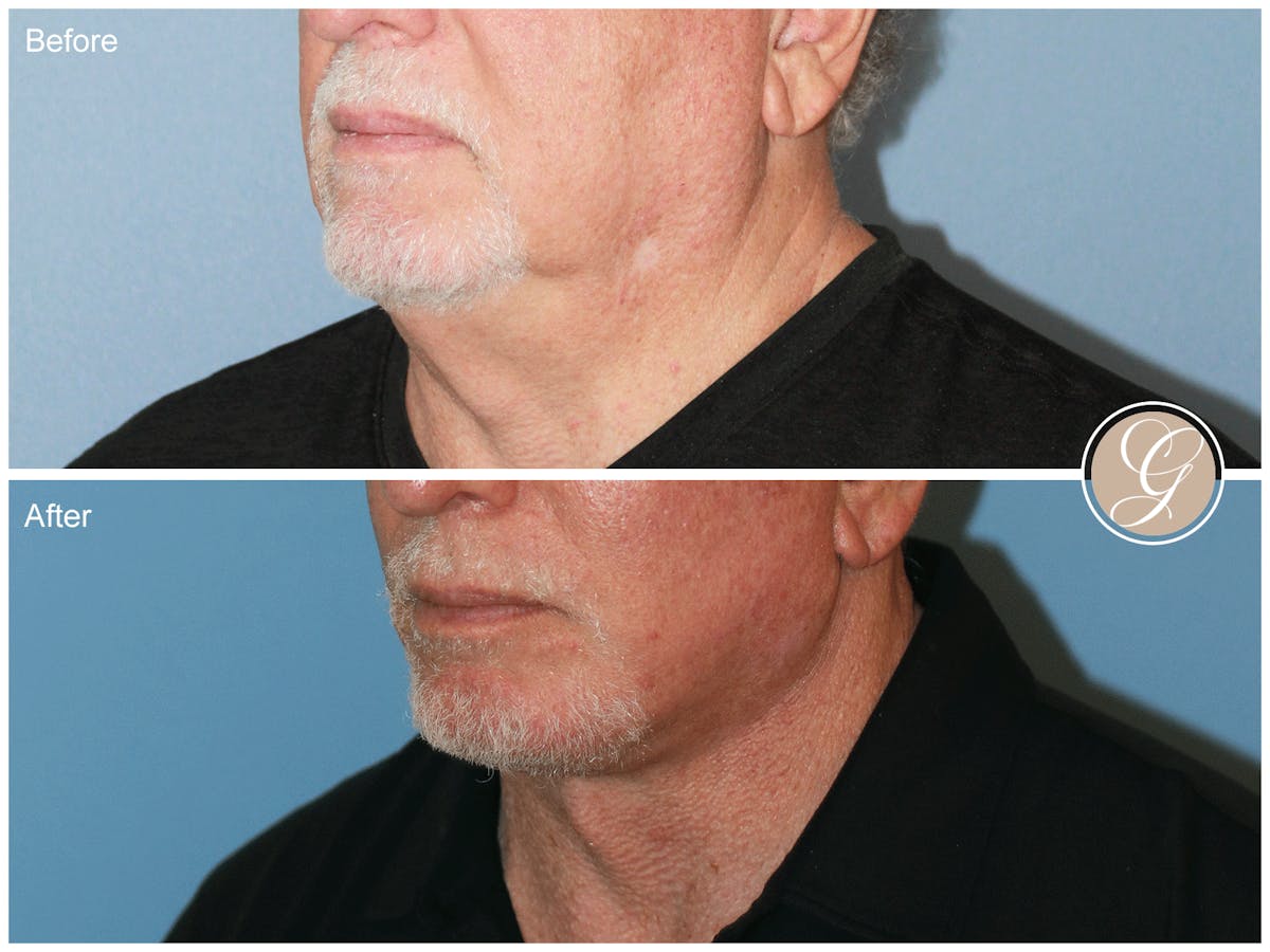 Facelift Male Before & After Gallery - Patient 123779 - Image 4