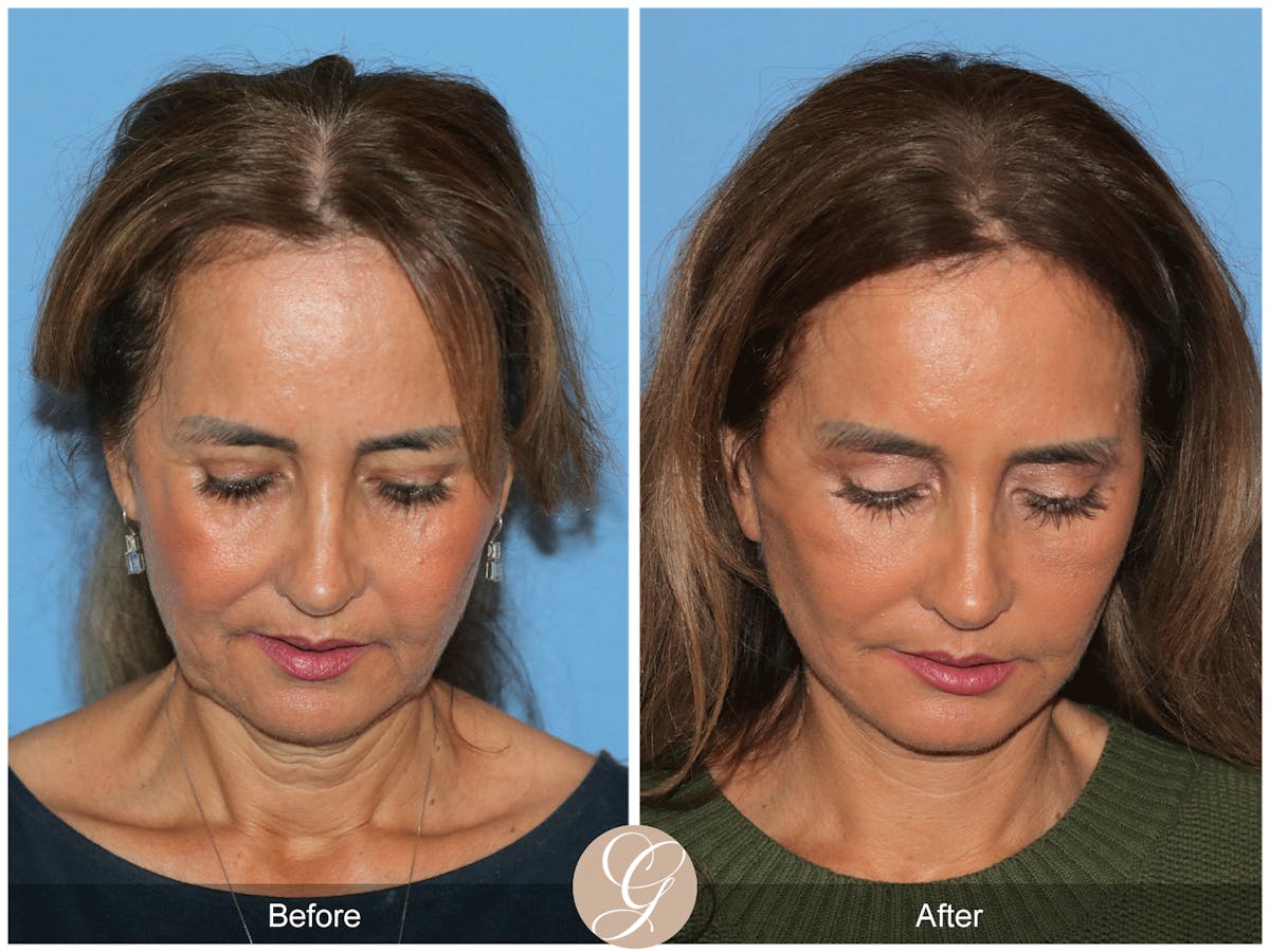 Preservation Facelift Before & After Gallery - Patient 167839 - Image 2