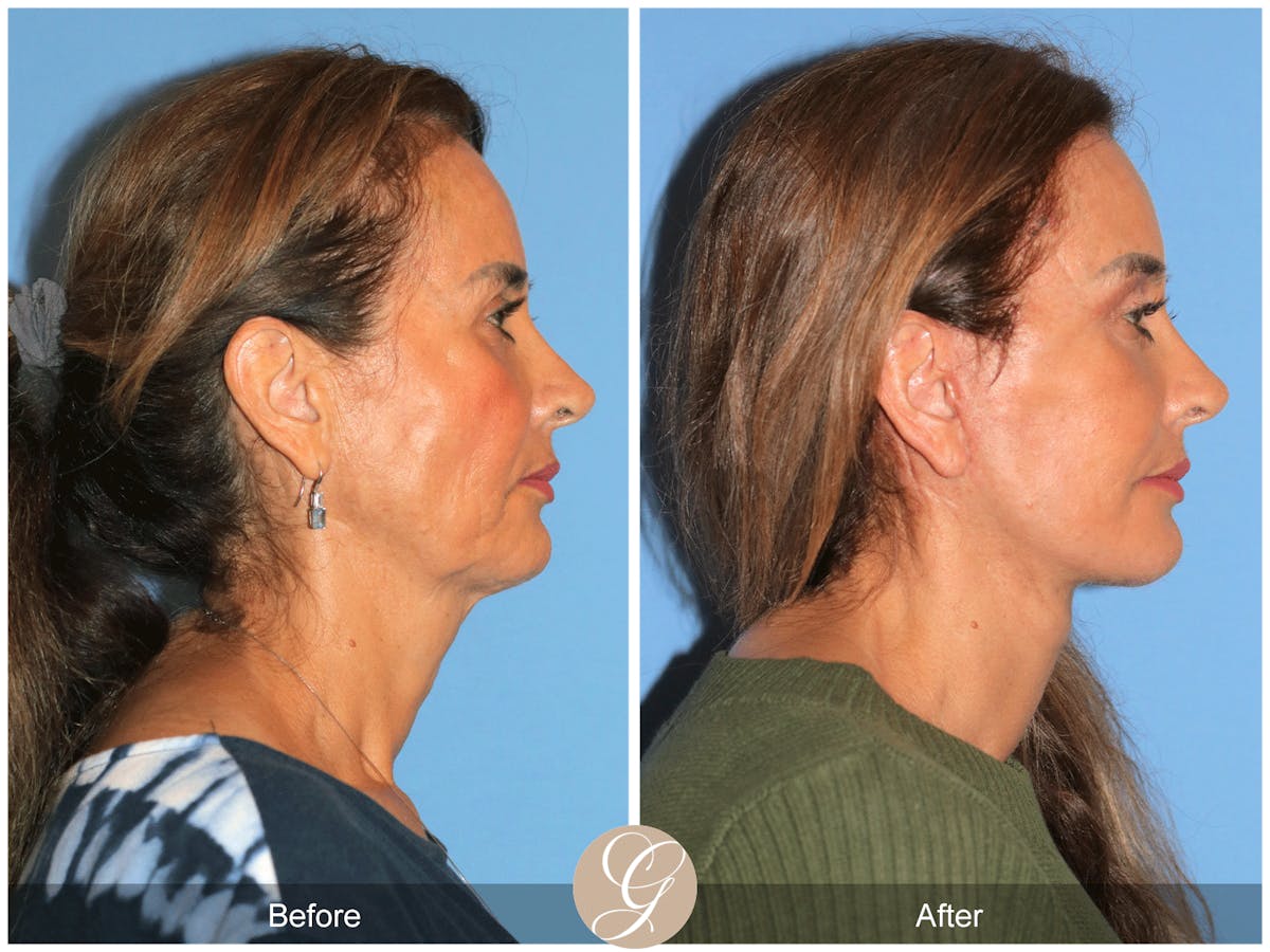 Preservation Facelift Before & After Gallery - Patient 167839 - Image 5